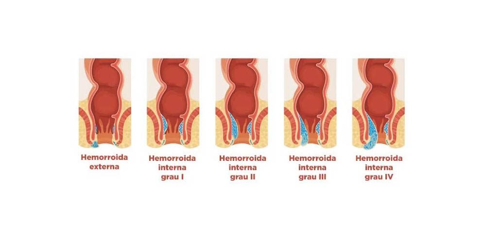 Como saber o grau da hemorroida? - Dr. Gustavo Braga - Coloproctologia ...